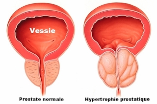 Prostate