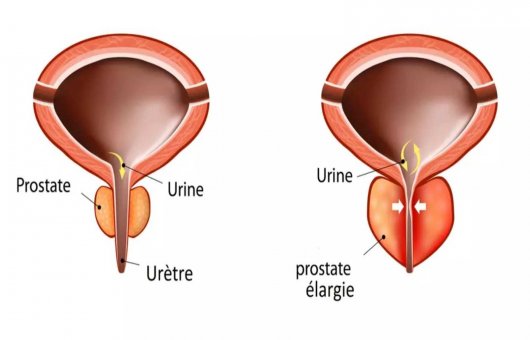 Kit Traitement Prostate