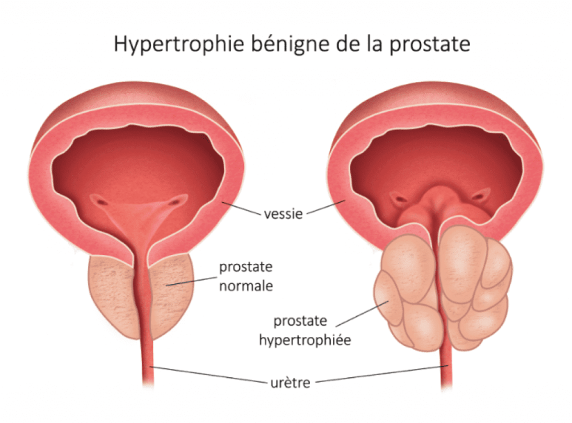 Hyperthrophie Bénigne de la Prostate